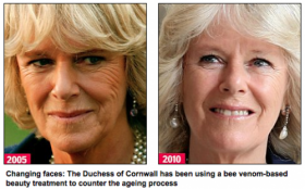 Before and after bee venom therapy to remove face wrinkles - Apitherapy